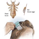 Can Bed Bugs Travel in Your Hair? 