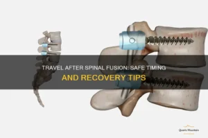 When Can I Travel After Spinal Fusion Surgery?